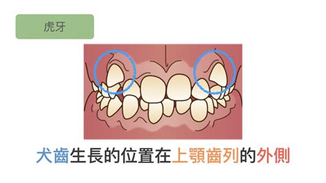 有虎牙代表什麼|亞洲人常見的虎牙也是一種咬合不正，介紹成因與治療。